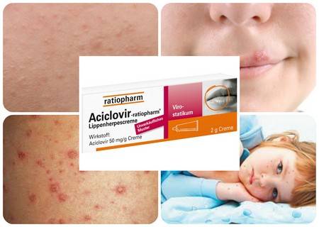Ацикловир от герпеса и ветрянки