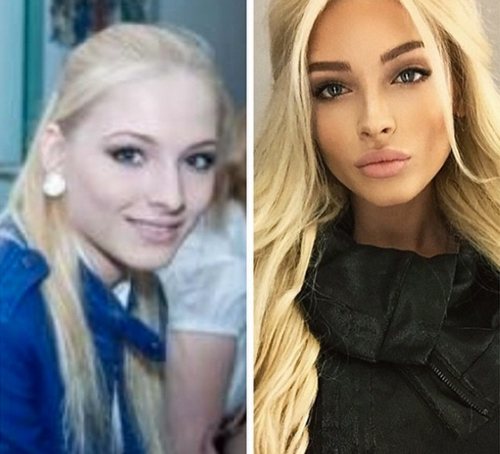 Алена Шишкова до и после пластики, какие пластические операции делала звезда, новости и фото 2019