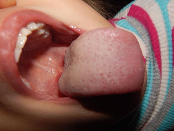 ангина у ребенка