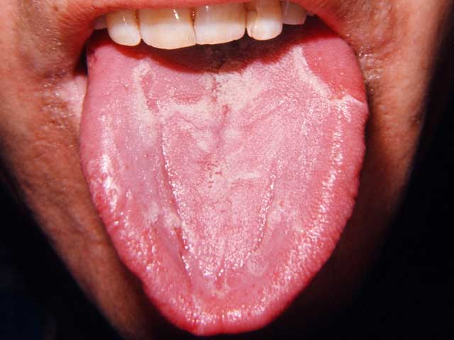 Десквамативный глоссит