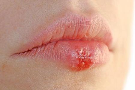 Герпес на губах при беременности.