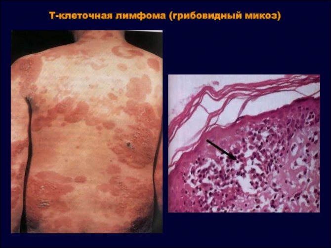 Грибовидный микоз кожи фото начальная стадия 4