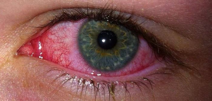 Хориоидит глаз