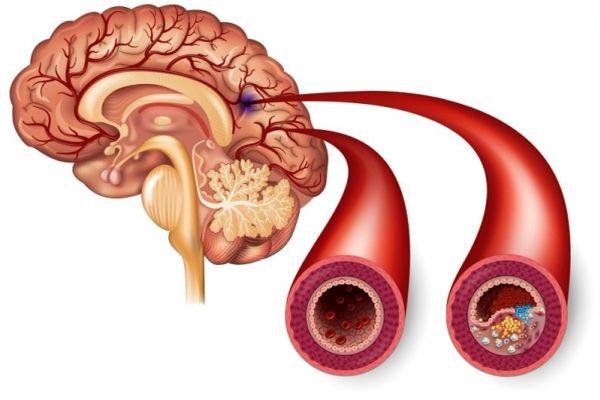 ишемия сосудов головного мозга