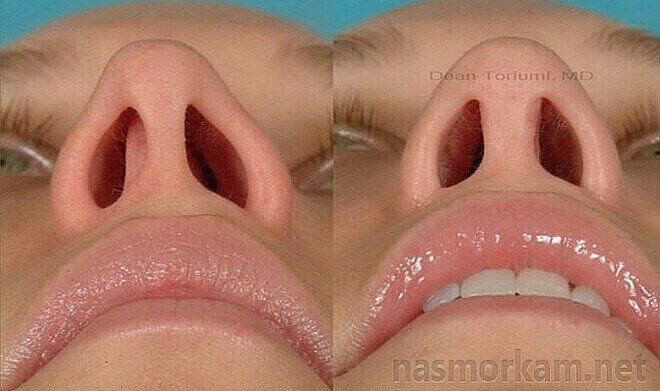 Искривление носовой перегородки