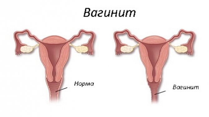 Как лечить вульвовагиноз у детей