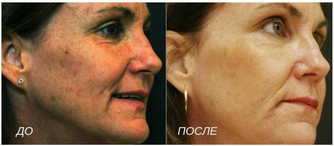 как ухаживать за лицом после косметических процедур