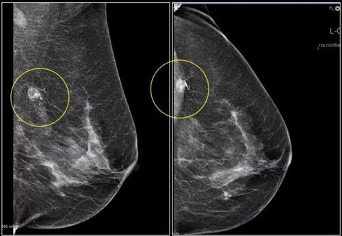 Кальцинаты в молочной железе: рассеянные и единичные микроуплотнения в груди, какое лечение