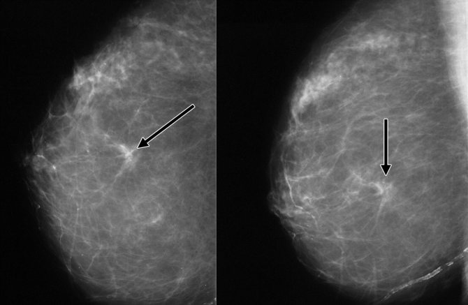 кальцинаты в молочной железе