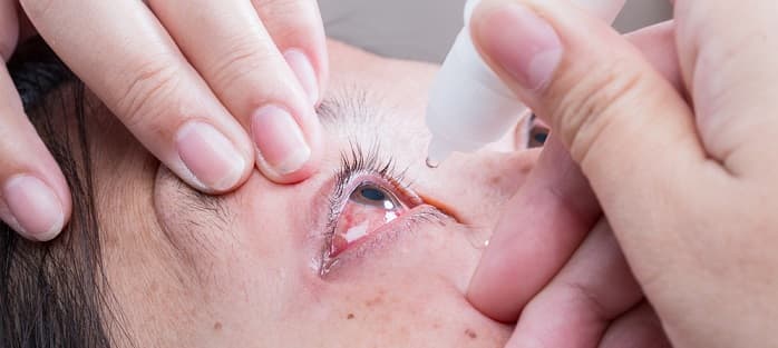 Кератит глаз