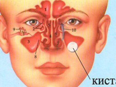 Киста верхнечелюстной пазухи: причины и лечение, симптомы, размеры для удаления