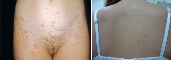 круговой лишай