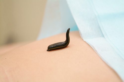 Лечение эндометрита гирудотерапией