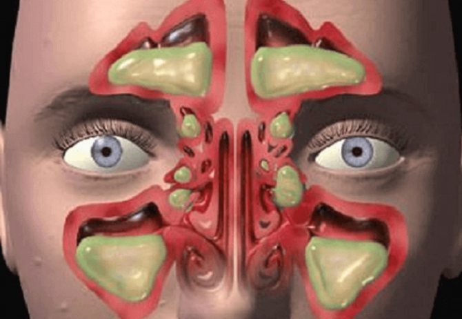 Лечение этмоидита у детей