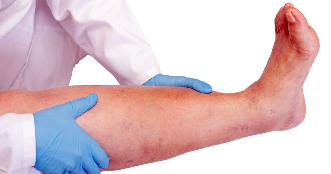 Лимфостаз нижних конечностей – лечение, причины