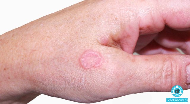 Лишай не чешется и не зудит