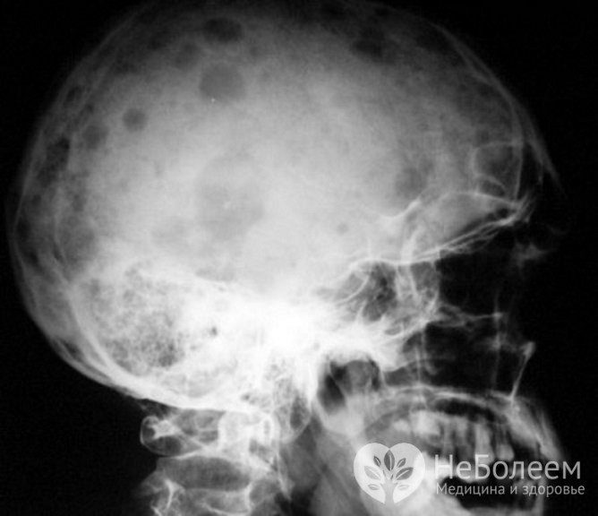 Миеломная болезнь характеризуется множественными поражениями, прежде всего, плоских костей, в том числе костей черепа