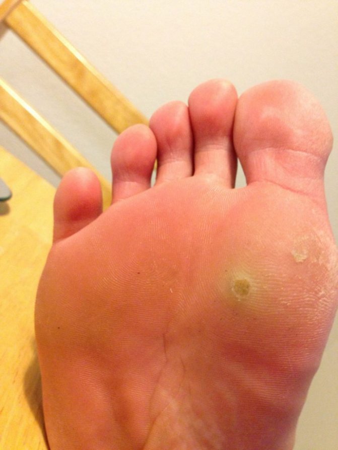 Мозоли на ногах: как избавиться от них народными методами или аптечными средствами и чем может помочь врач?