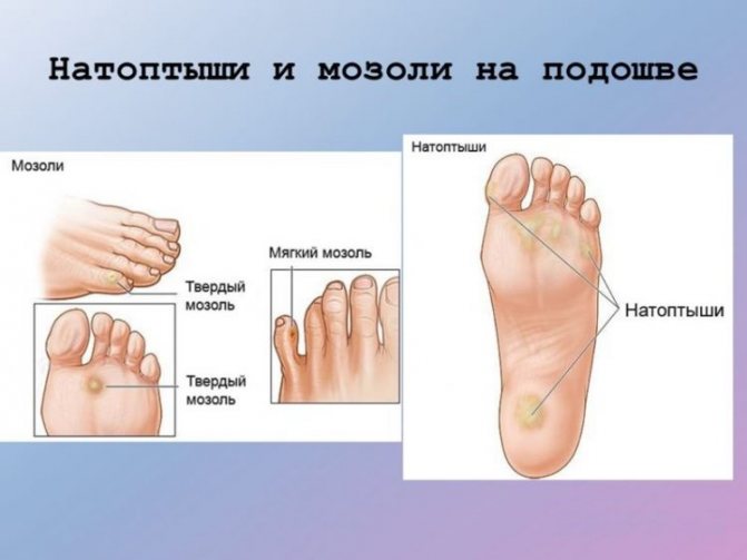 Мозоли на ногах: как избавиться от них народными методами или аптечными средствами и чем может помочь врач?