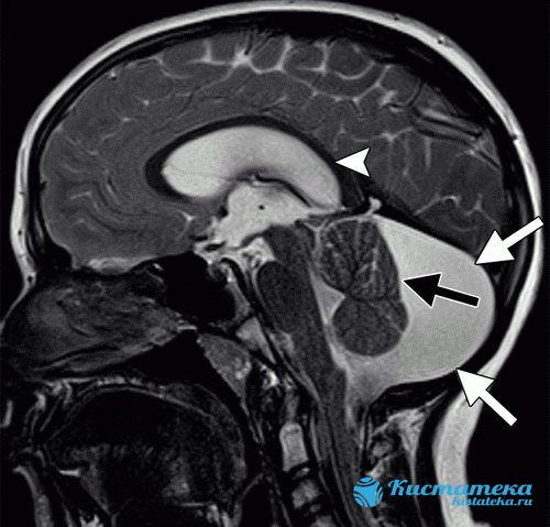 На изображении показана ретроцебеллярная арахноидальная киста с явным увеличением задней ямки (белые стрелки)
