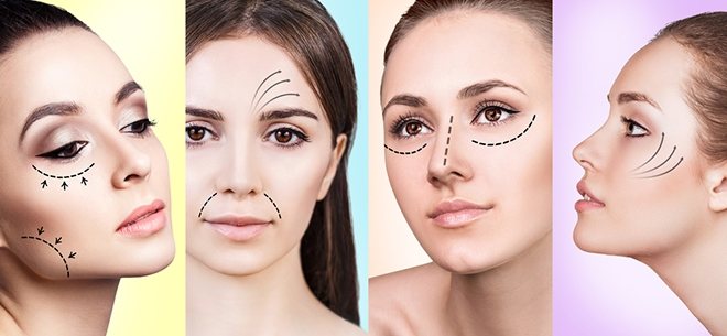 Нитевой лифтинг позволяет устранить визуальные дефекты в наиболее проблемных зонах