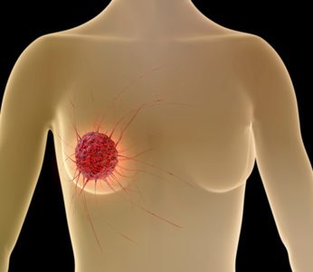 Онкология груди