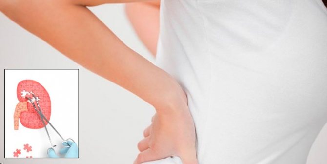 опасность образования песка в почках