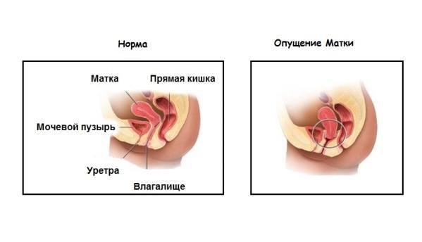 опущение матки симптомы