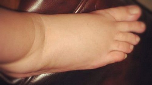 Отеки при сердечной недостаточности ⋆ Лечение Сердца