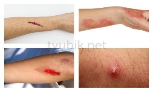 Повреждения кожного покрова