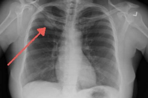 Рентгенограмма аденокарциномы лёгкого