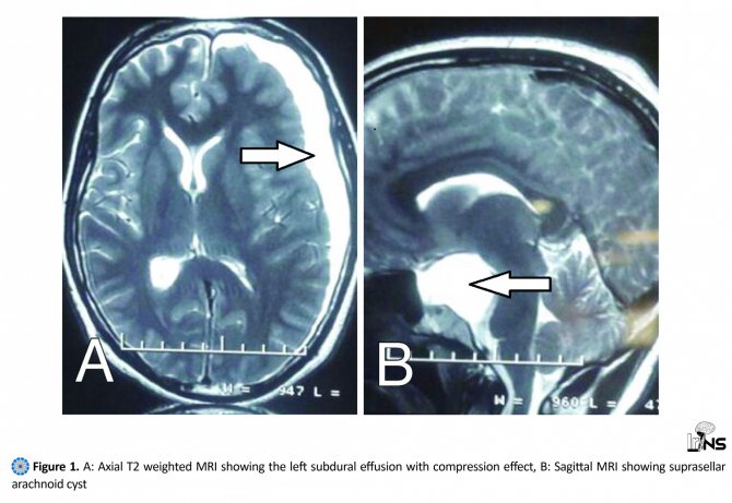 Ретроцеребеллярная киста головного мозга: опасность и лечение