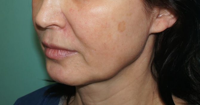 С возрастом кожа обвисает, лицо теряет привлекательность