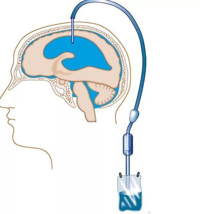 Шунтирование