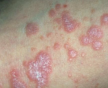 Симптомы красного плоского лишая у человека