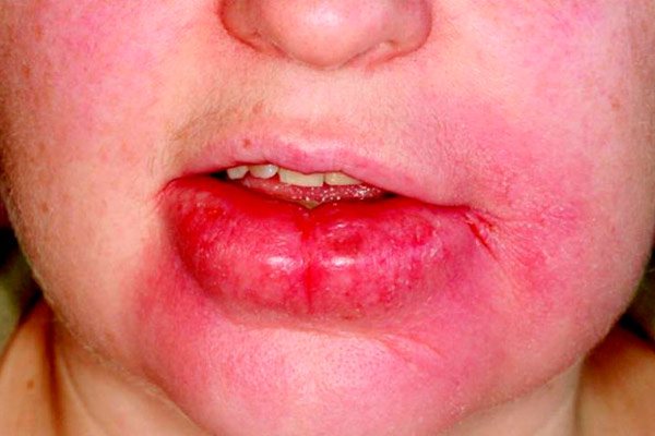 синдром вялой кожи