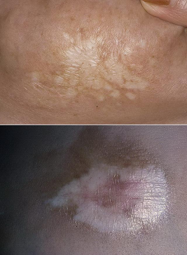 Склероатрофический лихен у девочек фото