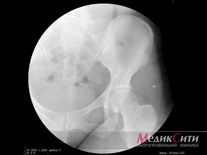 Спондилоартроз позвоночника: что это такое, как лечить