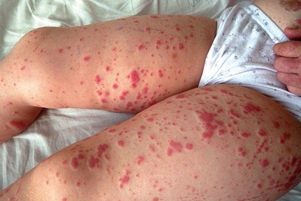 Сыпь экзантема фото