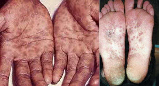 сыпь при сифилисе