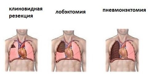 Виды операций при раке лёгкого