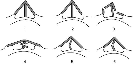 Восстановление носа после травмы