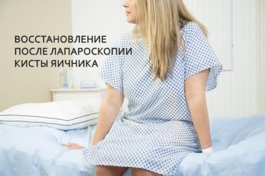 Восстановление после лапароскопии кисты яичника