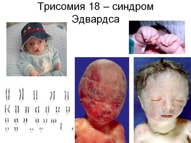Фото новорожденных с синдромом эдвардса