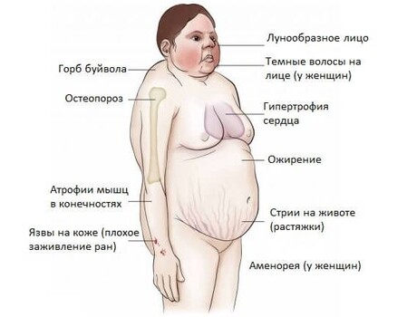Основные симптомы болезни Иценко-Кушинга Синдром лица в форме полной луны