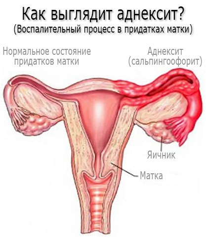 Как выглядит аднексит? Симптомы аднексита (сальпингоофорита) Как выглядит аднексит? Симптомы аднексита (сальпингоофорита)