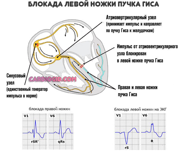 блокада-левой-ножки-гиса3jpg