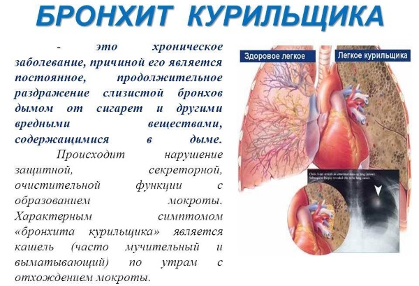 Как лечить хронический бронхит курильщика. Симптомы и лечение, препараты, народные средства, антибиотики