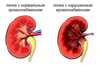 Как выглядят здоровые и больные почки Как выглядят здоровые и больные почки