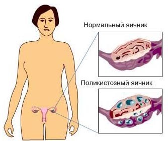 Поликистозный яичник Поликистозный яичник
